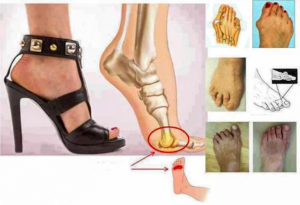 metatarsalgia-rocchi